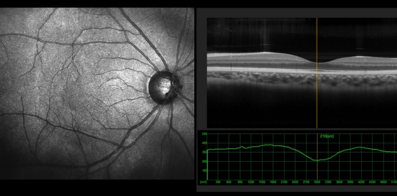 eye diseases detection