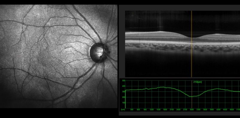 importance of advanced eye exams 