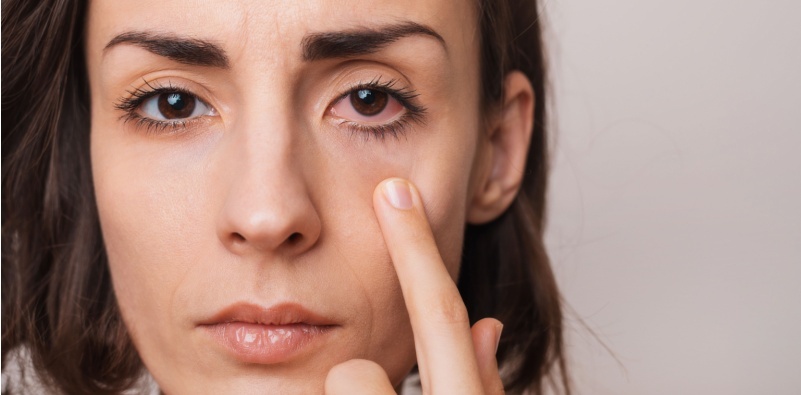 Close-up of a woman pointing to her red, irritated dry eye.